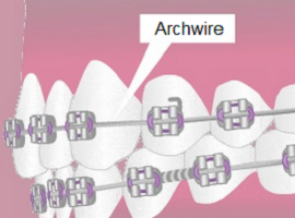 Parts of braces - Archwires