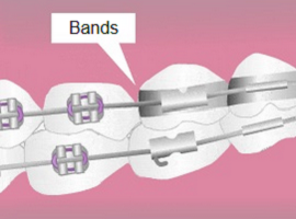 Parts of braces - Bands