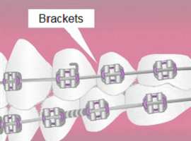Parts of braces - Brackets