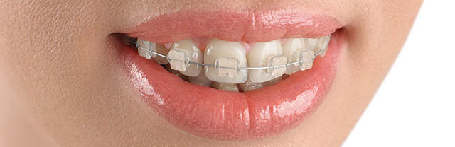 Types of braces - Ceramic Braces