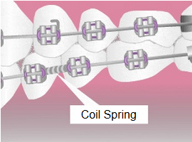 Parts of braces - Coil Spring