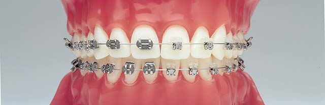Types of braces - Damon®