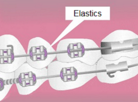 Parts of braces - Elastics