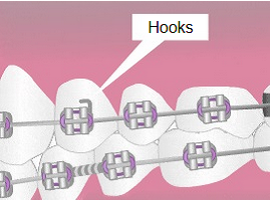 Parts of braces - Hooks