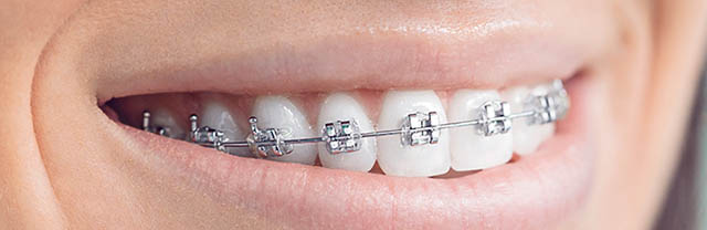 Types of braces - Metal Braces