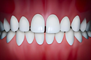 Perfect white teeth aligned in straight rows against pink gum background, demonstrating orthodontic results.
