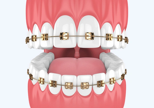 Dental model displaying upper and lower teeth with gold and white orthodontic braces installed.