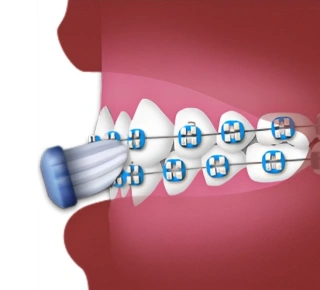 Ceramic braces with blue brackets and wires attached to teeth against pink gum background