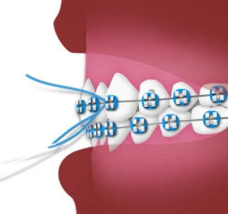 Blue braces attached to upper and lower teeth with elastic bands visible on red mouth background.