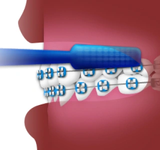 Blue toothbrush with white dental braces against pink background for orthodontic care.