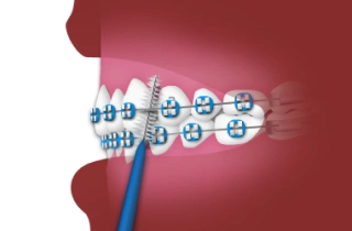 Close-up of metal braces on teeth with blue toothbrush cleaning brackets and wires.