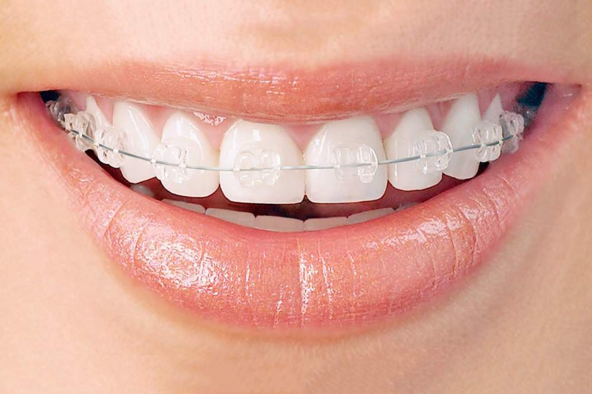 Ceramic Braces in Mayfield Village