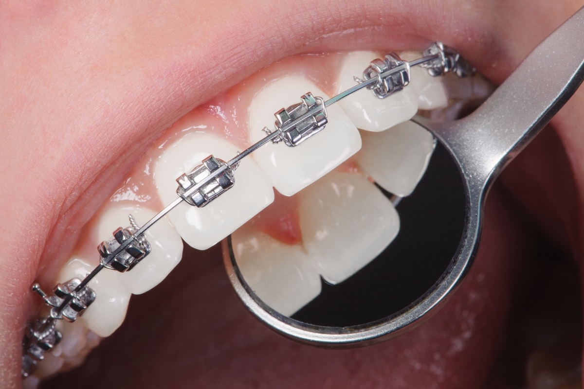 Orthodontic Treatment Mayfield